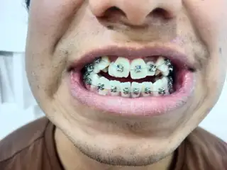 Manejo ortodóntico en casos complejos con brackets de autoligado — paso 4 de 4 · White Smile Odontología, Chapinero, Bogotá