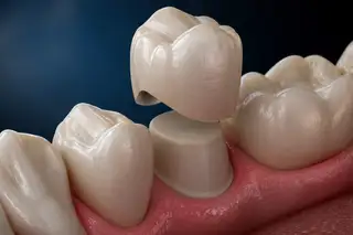 Coronas en zirconio — paso 2 de 2 · White Smile Odontología, Chapinero, Bogotá