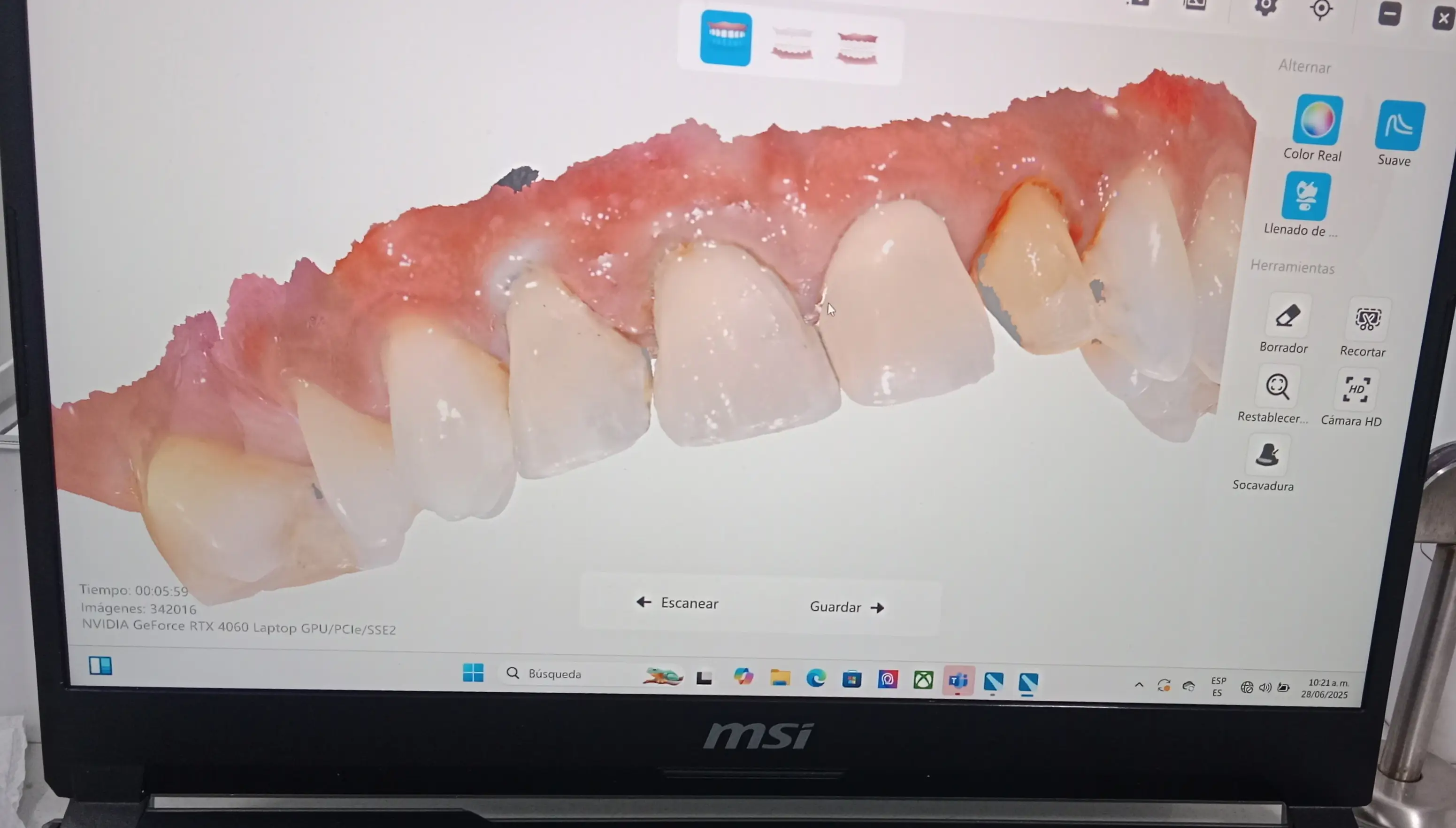 Coronas en zirconio — paso 1 de 2 · White Smile Odontología, Chapinero, Bogotá