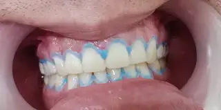 Aclaramiento dental en consultorio — paso 2 de 2 · White Smile Odontología, Chapinero, Bogotá