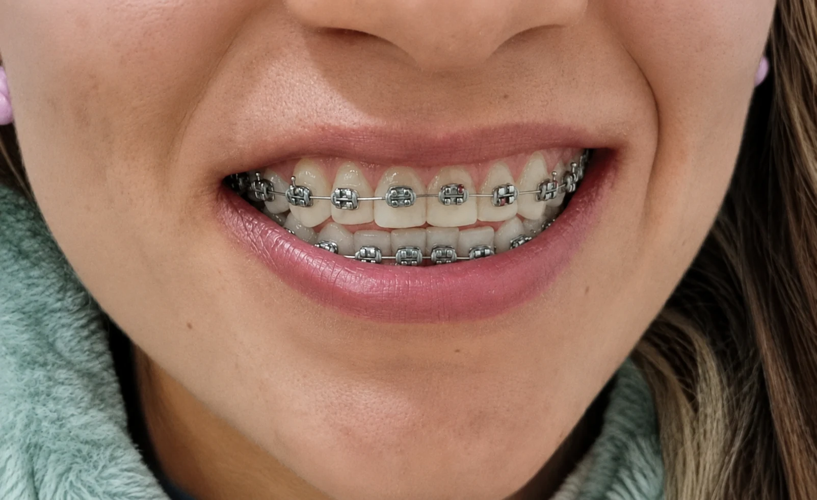 Tratamiento de ortodoncia con brackets y alineadores